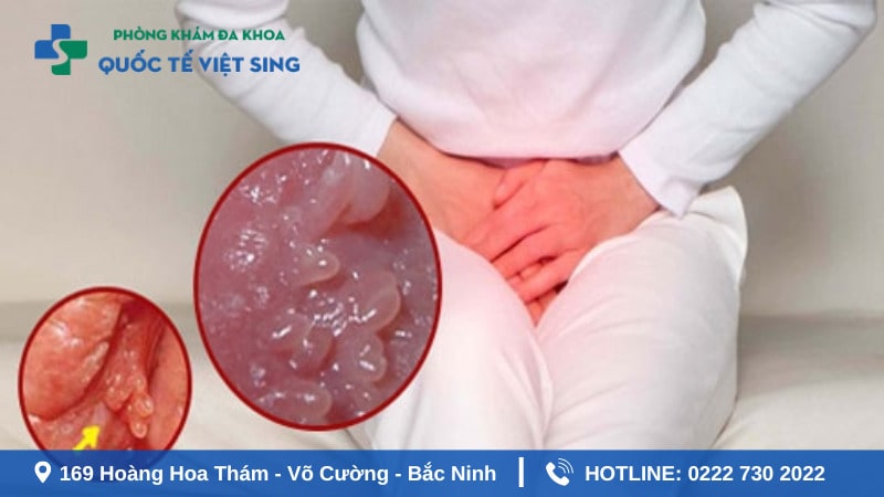 Phương pháp điều trị gai sinh dục và sùi mào gà ở nữ hiệu quả