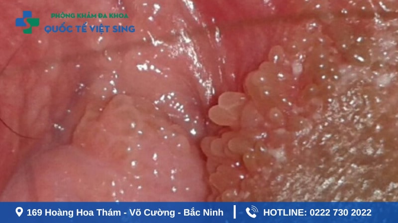 Cách phân biệt gai sinh dục và sùi mào gà ở nữ