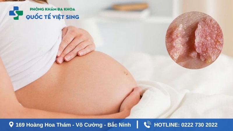 Dấu hiệu sùi mào gà khi mang thai chị em cần chú ý