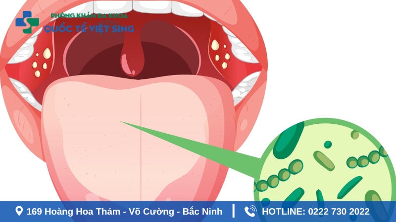 Dấu hiệu nhận biết sùi mào gà ở lưỡi