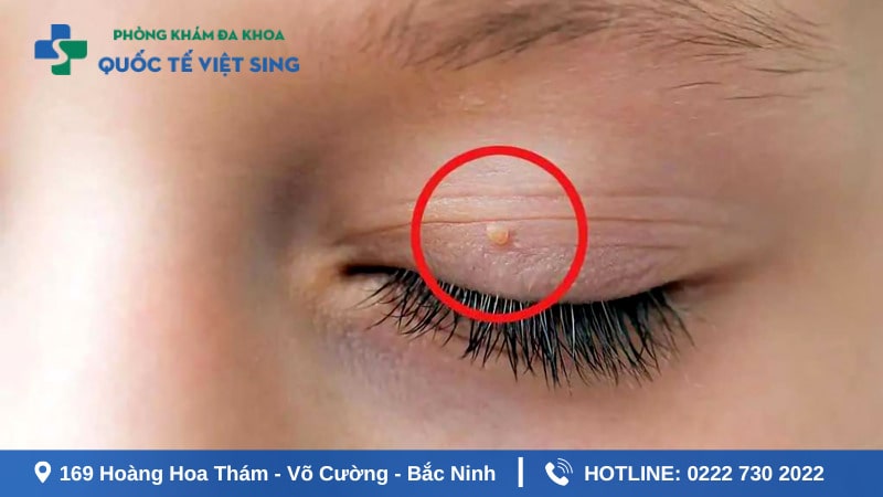 Nhận biết dấu hiệu sùi mào gà ở mắt qua từng giai đoạn