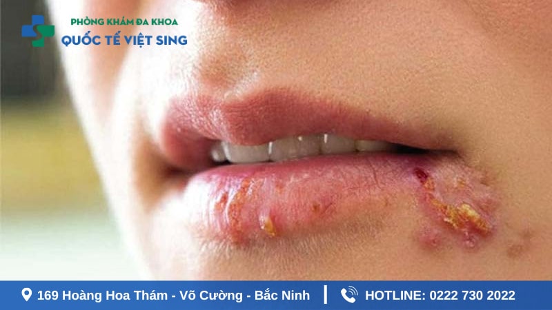 Sùi mào gà ở miệng có thể bị nhầm lần với nhiệt miệng