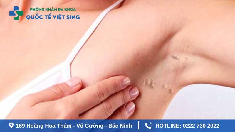 Dấu hiệu nhận biết sùi mào gà ở nách
