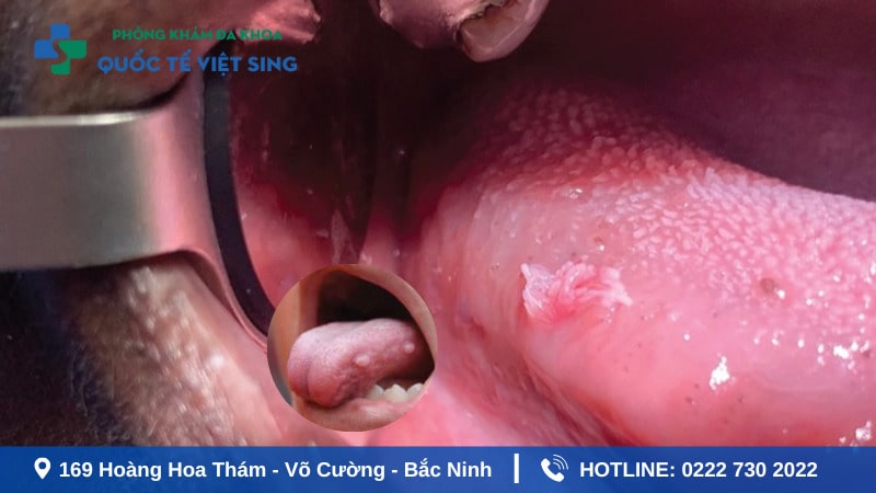 Các nốt sùi phát triển nhanh chóng khi không được điều trị