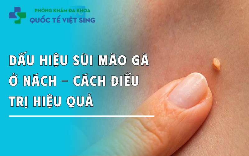 https://dakhoaquoctebacninh.com/wp-content/uploads/2025/08/dau-hieu-sui-mao-ga-o-nach-va-cach-dieu-tri-hieu-qua.jpg