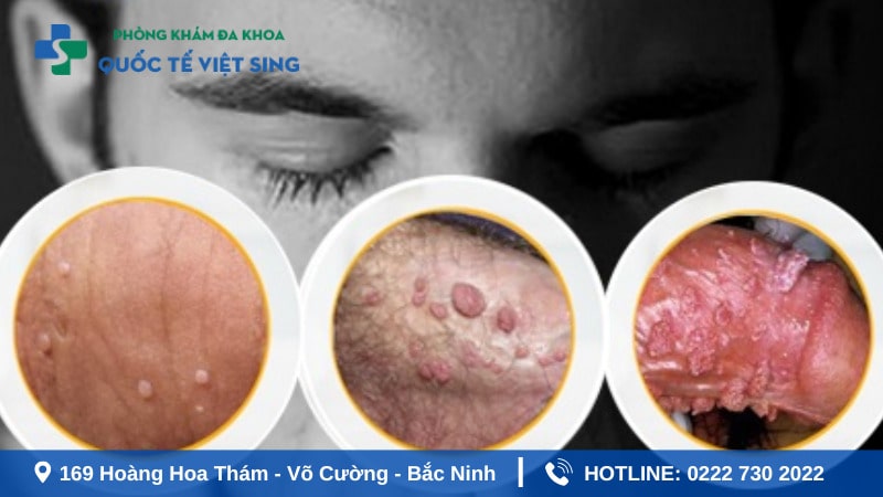 Nhận diện sớm dấu hiệu sùi mào gà giúp nam giới chủ động thăm khám, điều trị hiệu quả