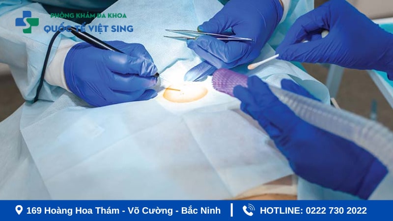 Phương pháp điều trị sùi mào gà ở từng vị trí hiệu quả