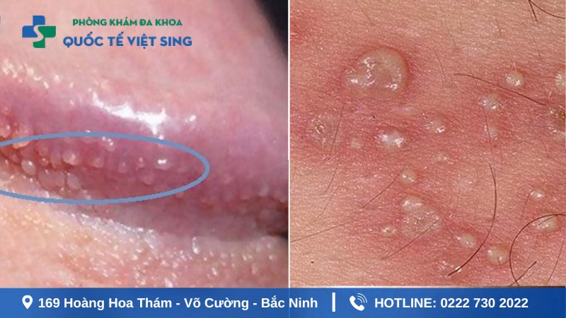 Phân biệt hạt ngọc dương vật và sùi mào gà ở nam giới