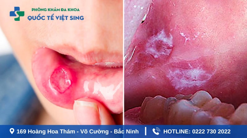 Hiểu đúng về trình trạng sùi mào gà ở miệng