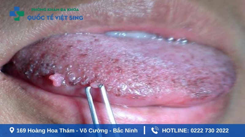 Hình ảnh sùi mào gà xung quanh lưỡi