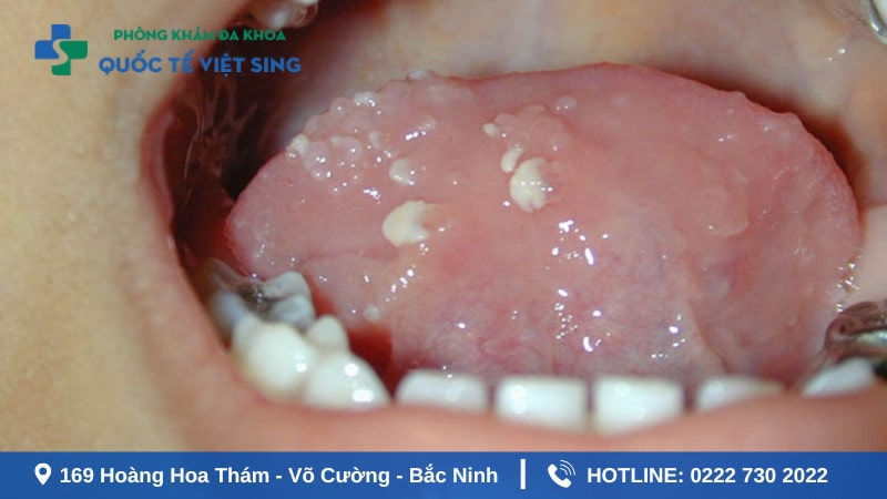 Hình ảnh sùi mào gà ở trên lưỡi