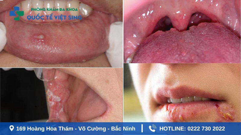 Hình ảnh sùi mào gà ở miệng cần chú ý