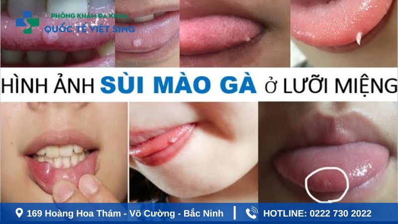 Hình ảnh sùi mào mào gà ở miệng lưỡi cần chú ý