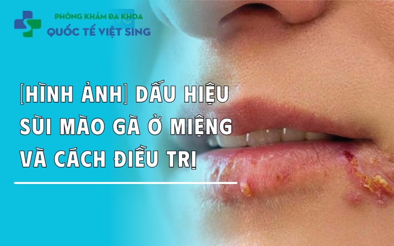 [Hình ảnh] Dấu hiệu sùi mào gà ở miệng và cách điều trị