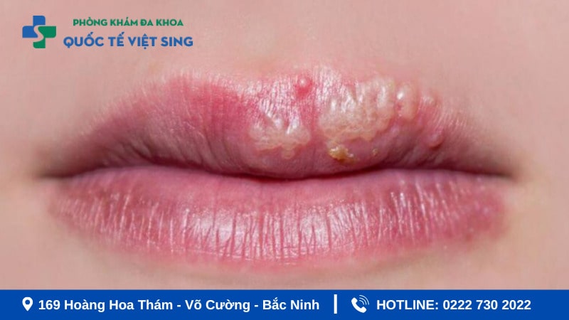 Sùi mào gà ở môi