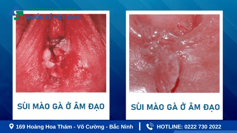 Hình ảnh nhận biết bệnh sùi mào gà ở nữ tại âm đạo