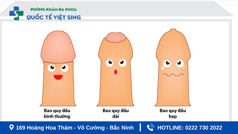 Trường hợp nào nam giới cần cắt bao quy đầu ngay?