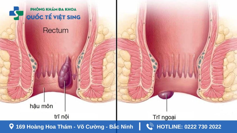 Khi nào cần đi khám trĩ? - Thời điểm không nên bỏ qua