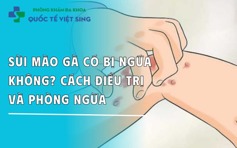 Sùi mào gà có bị ngứa không? Cách điều trị và Phòng ngừa