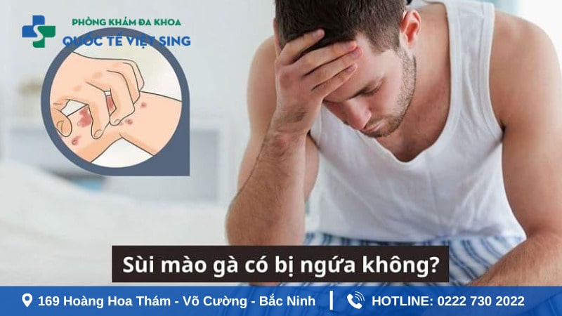 Sùi mào gà có bị ngứa không ?