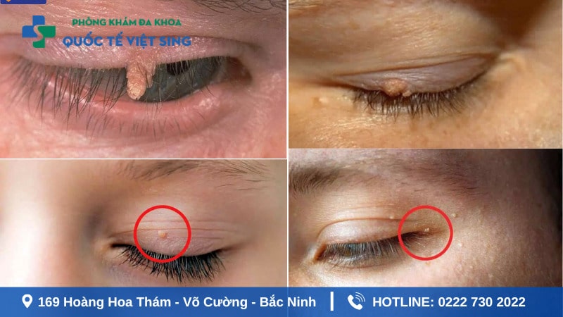 Hình ảnh sùi mào gà ở mắt ở nam và nữ cần chú ý