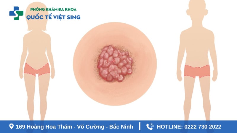 Yếu tố và nguyên nhân bị sùi mào gà ở nam và nữ