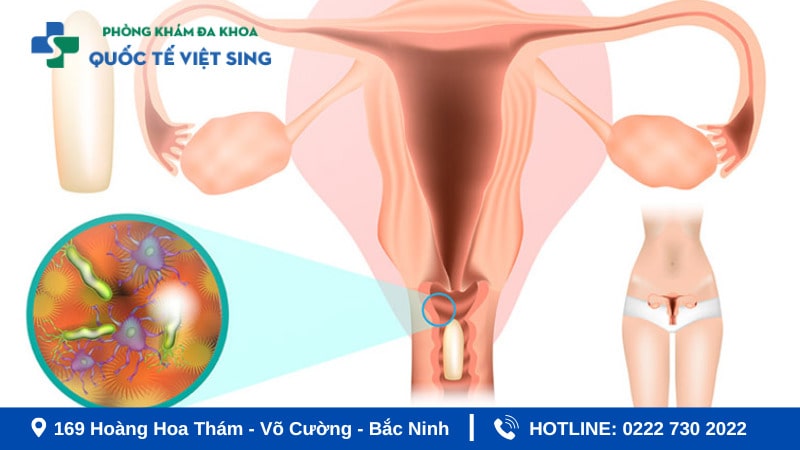 Nguyên nhân dẫn đến tình trạng viêm âm đạo