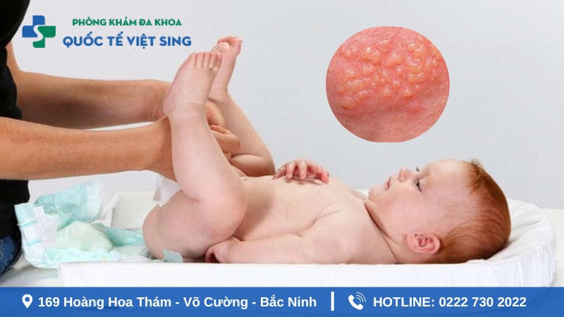 Nguyên nhân gây sùi mào gà ở trẻ cha mẹ cần phải biết