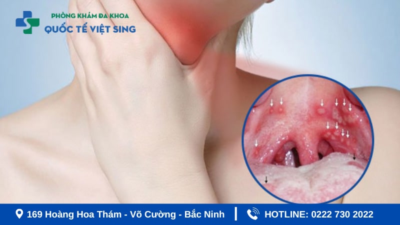 Nguyên nhân gây sùi mào gà ở họng