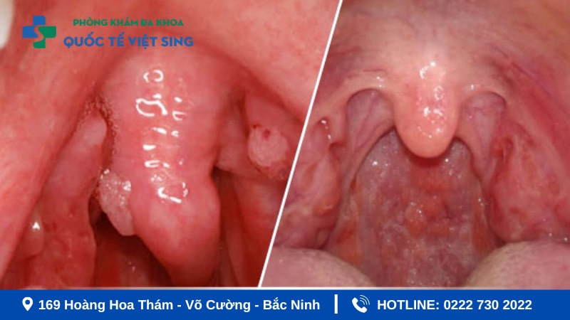 Phân biệt sùi mào gà ở họng với viêm họng hạt
