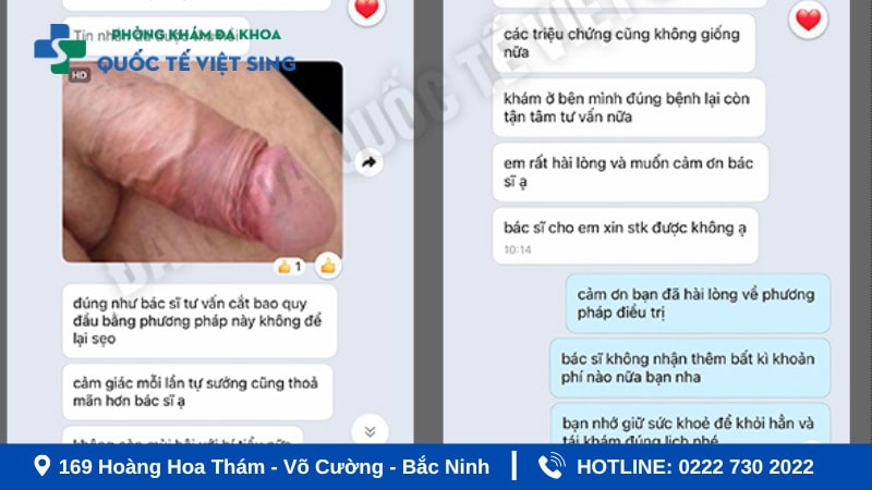 Phản hồi của bệnh nhận khi cắt bao quy đầu tại Việt Sing