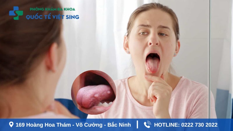 Phân loại các dạng sùi mào gà ở lưỡi