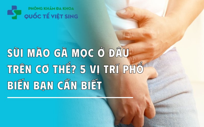 Sùi mào gà mọc ở đâu trên cơ thể? 5 vị trí phổ biến bạn cần biết