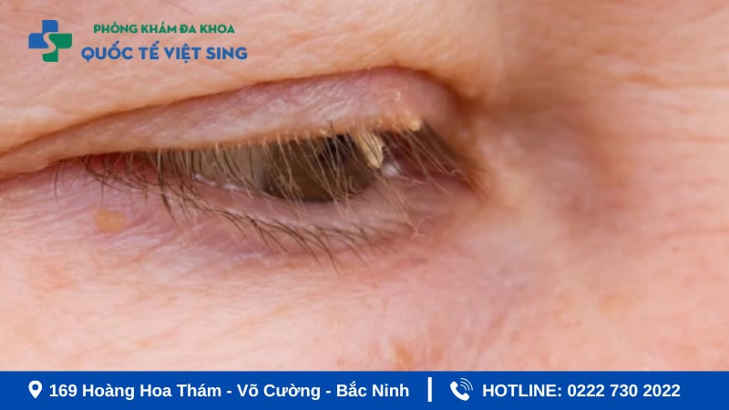 Sùi mào gà ở mắt