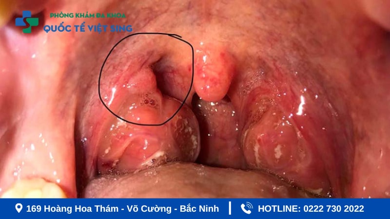 Bệnh sùi mào gà ở cổ họng biểu hiện như nào?
