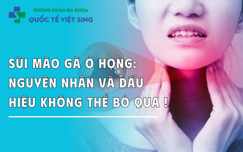 Sùi mào gà ở họng: Nguyên nhân và dấu hiệu không thể bỏ qua