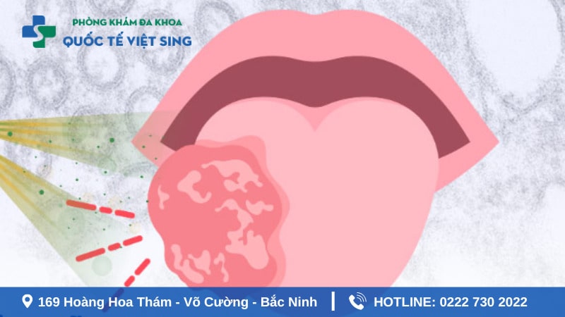 Bs CKI. Nguyễn Văn Tường cho biết: Sùi mào gà ở lưỡi có thể chưa được