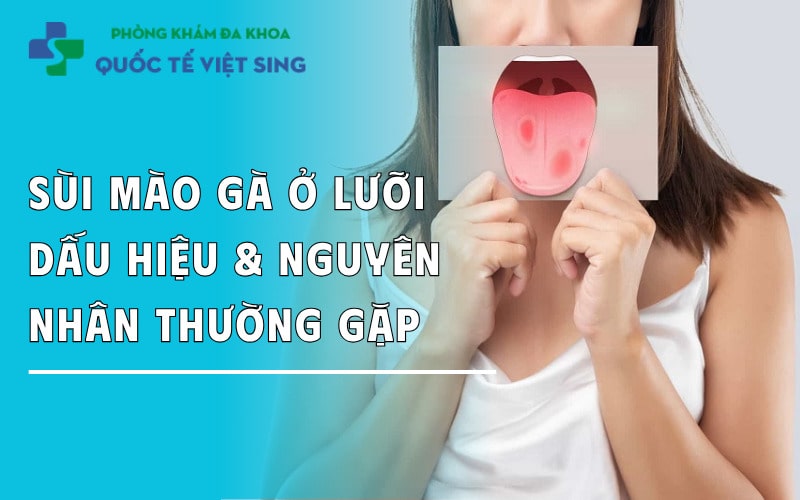 https://dakhoaquoctebacninh.com/wp-content/uploads/2025/08/sui-mao-ga-o-luoi-dau-hieu-nguyen-nhan-cach-dieu-tri.jpg