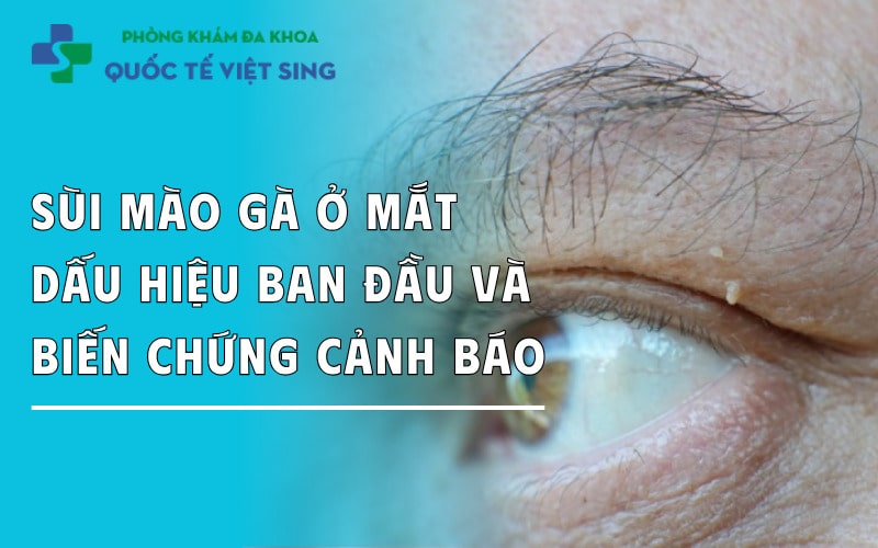 Sùi mào gà ở mắt: Dấu hiệu ban đầu Và biến chứng nguy hiểm