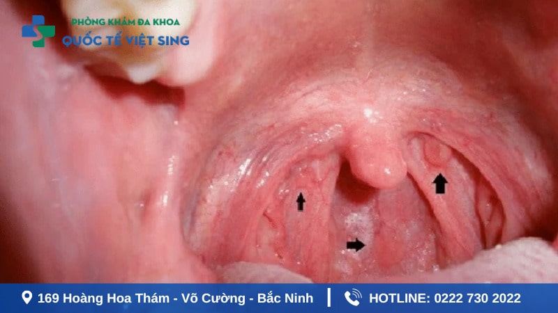 Bị sùi mào gà ở miệng tăng nguy cơ ung thư vòng họng