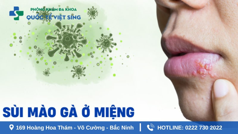 Bệnh sùi mào gà ở miệng là gì?