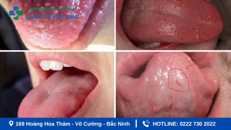 Sùi mào gà ở miệng, lưỡi