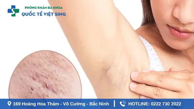 Sùi mào gà ở nách gây biến chứng nguy hiểm gì?