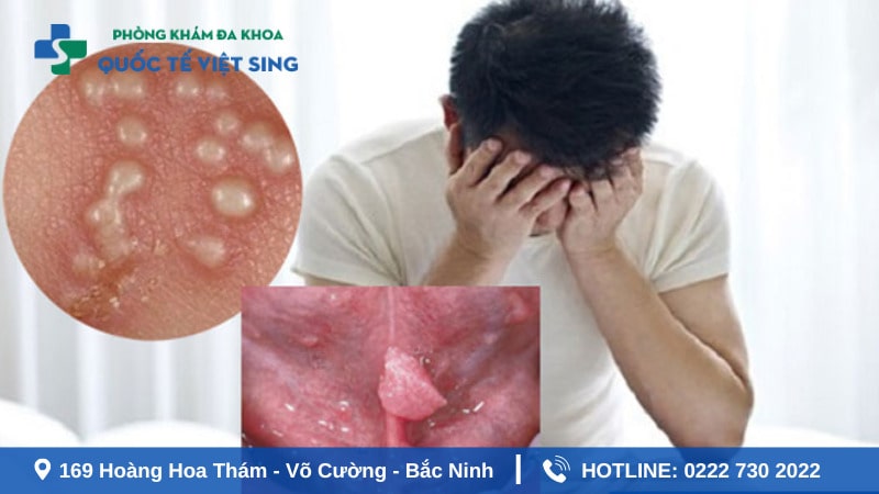 Sùi mào gà càng kéo dài càng gây nhiều biến chứng nguy hiểm.