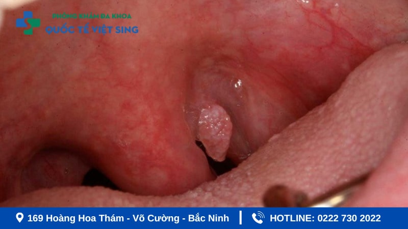 Sùi mào gà ở cổ họng