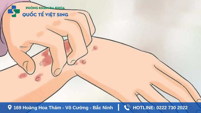 Tìm hiểu về bệnh sùi mà gà