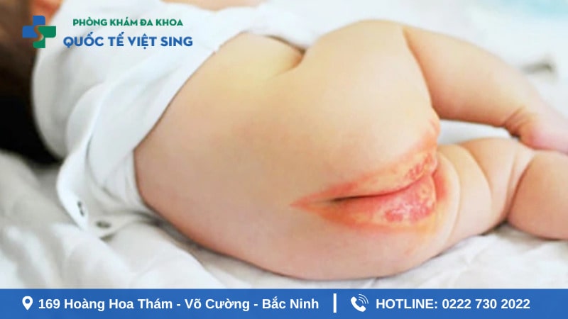 Trẻ bị sùi mào gà không nguy hiểm những gây khó chịu