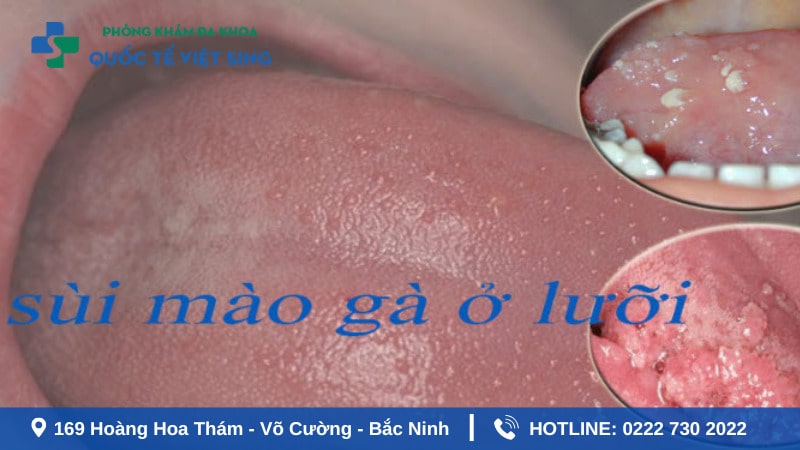 Yếu tố giúp điều trị sùi mào gà ở lưỡi dứt điểm