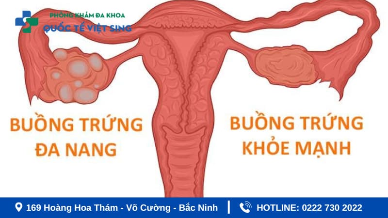 Buồng trứng đa nang chiếm 6-10% trong các bệnh phụ khoa thường gặp