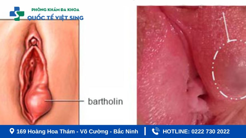Dấu hiệu viêm phụ khoa - Âm đạo, âm hộ sưng đỏ